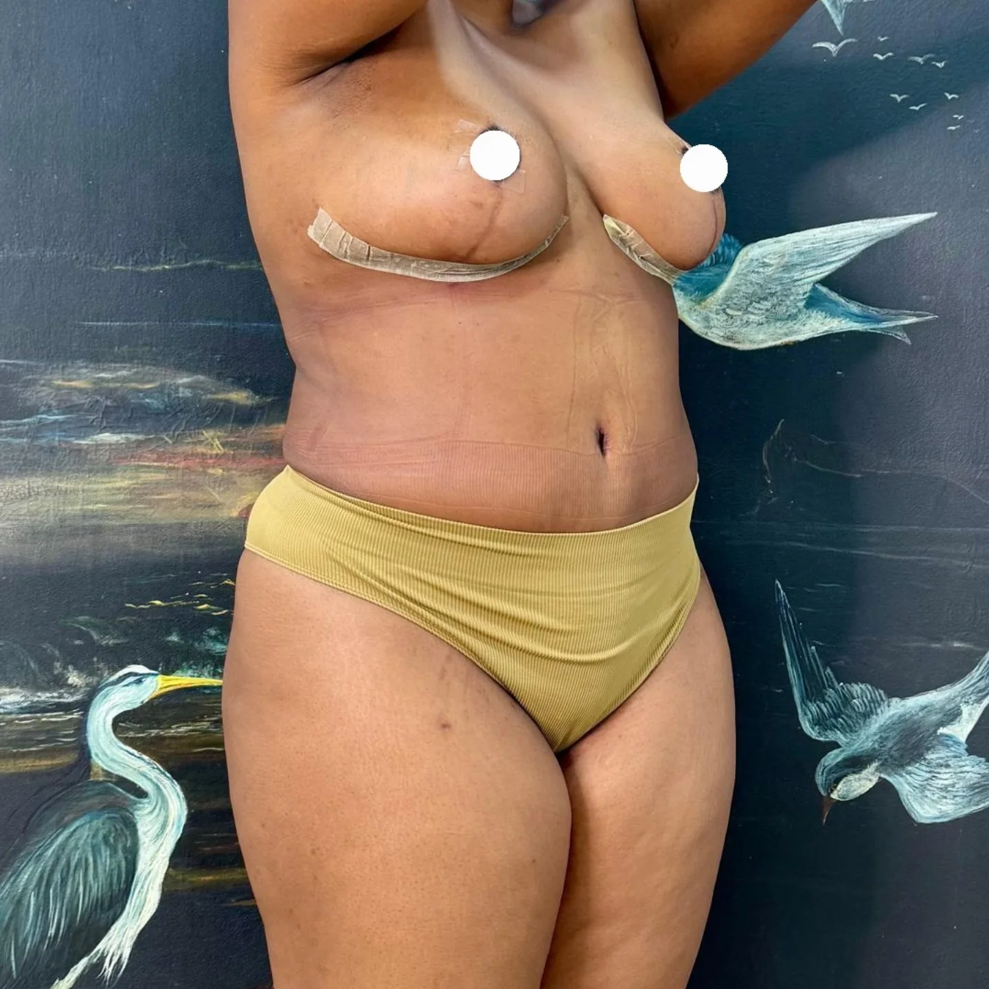Mommy Makeover Reduction and Tummy Tuck After